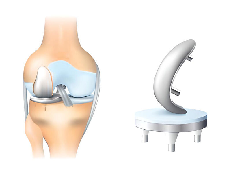 knee-replacement-surgery-01